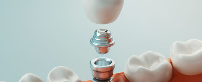 Dental Implants vs. Dentures: Finding Your Perfect Smile