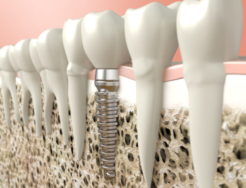 Rediscover the Joy of Eating with Dental Implants