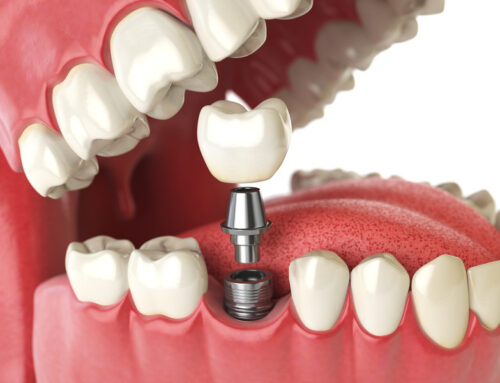 Navigating Dental Implants: Your Guide to a New Smile