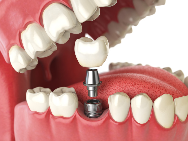 Navigating Dental Implants: Your Guide to a New Smile