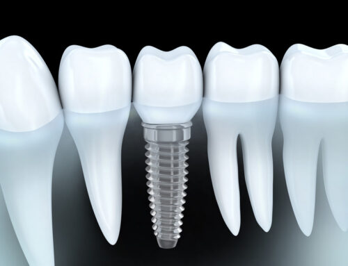 Dental Implants: Cavity-Free Smiles for a Lifetime